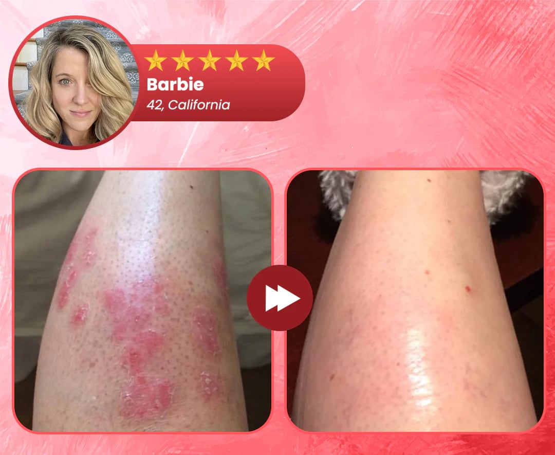 Natravor® DermSoothe Psoriasis Relief Spray
