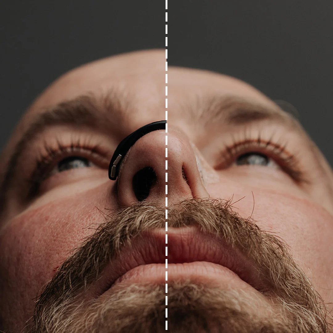 Fix Your Deviated Septum