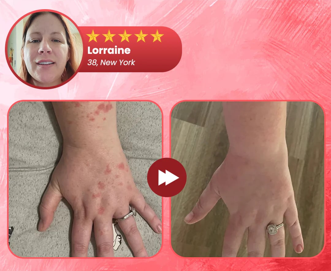 Natravor® DermSoothe Psoriasis Relief Spray